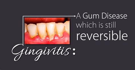 Gum Disease Begins As Gingivitis Which In This Early Stage Is Still