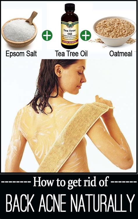 6 simple and easy ways to get rid of back acne beauty pinterest acne remedies back acne