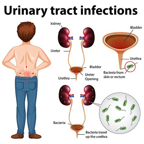 Urinary Tract Infection Uti Symptoms Causes And Treatment Hot Sex Picture