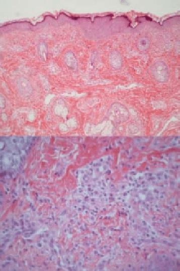 Histopathology Showing The Papillary Dermal Pattern Of Benign Cephalic