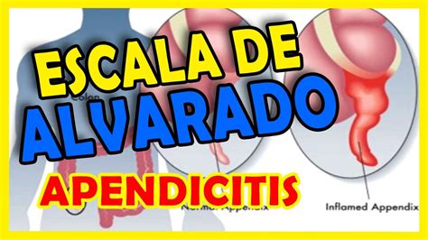 Escala De Alvarado Apendicitis Aguda Youtube