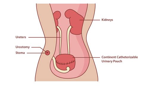 Urostomy Complications What To Expect After Your Surgery Compactcath