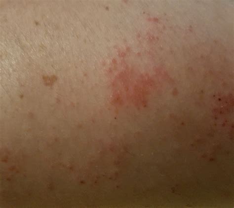 az allergiás betegségek helmintikus kezelése)