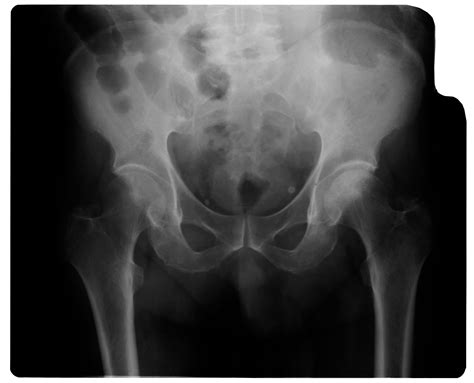 Osteoarthritis X Ray Hip