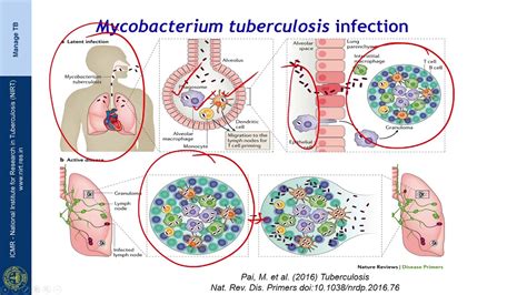 Tuberculosis Pathogenesis Flowchart