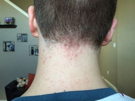 How Do I Get Rid Of Acne On The Back Of My Neck At Hairline R
