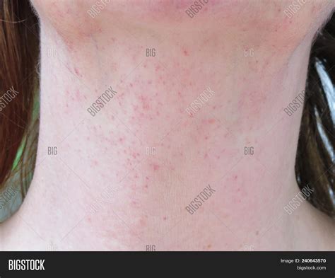 Rash On Neck Caused By Image And Photo Free Trial Bigstock