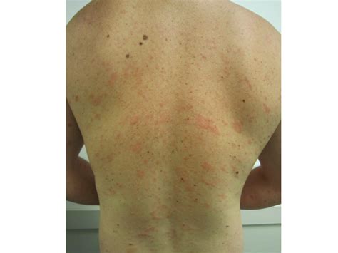 If home remedies don't ease symptoms or shorten the duration of pityriasis rosea, your doctor may prescribe medicine. Pityriasis Rosea