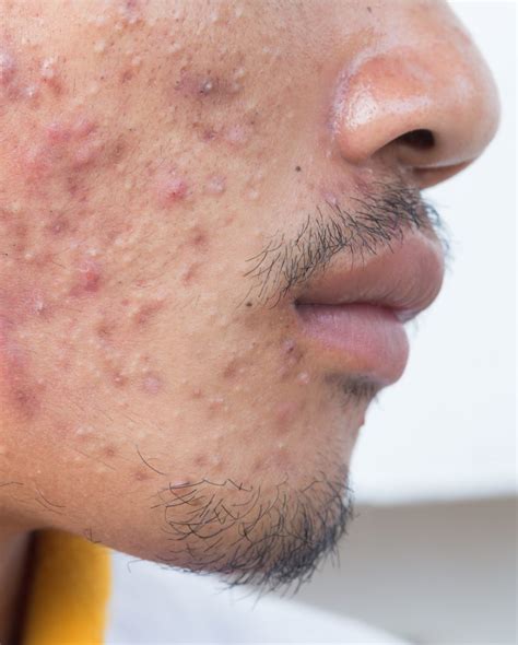 Acne And Acne Scarring Treatments Graceful Wellness