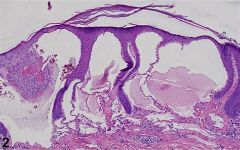 Papulovesicular Lesions Near The Right Breast Jaad Case Reports