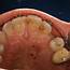 Surgical Exposure Of Impacted Canine  Spyros Kouris Periodontist
