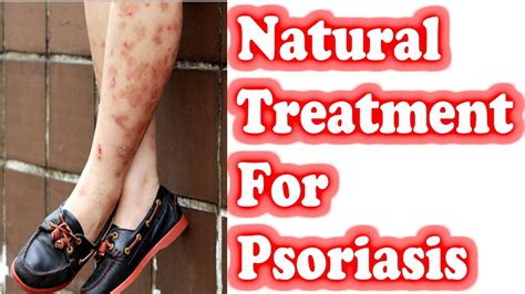 Treatment Of Psoriasis Psoriasis Home Remedies Youtube