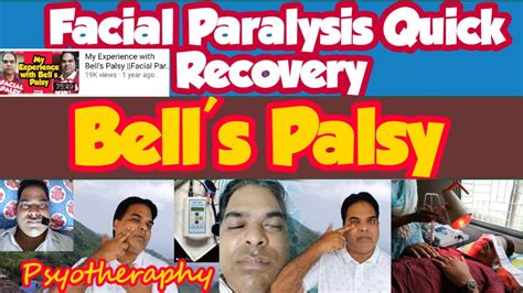 Bells Palsy Recovery Facial Paralysis Treatment And Exercises How To Recover From Bells
