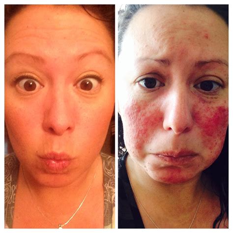 Before And After Pic Just Only 4 Weeks Of Progress Into Getting My Rosacea Un