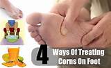Home Remedies Corn Removal