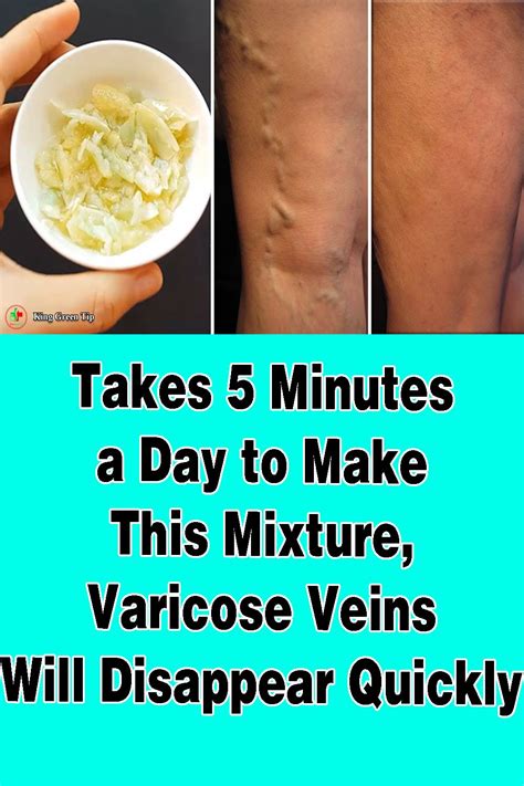 Pin On How To Treat Varicose Veins