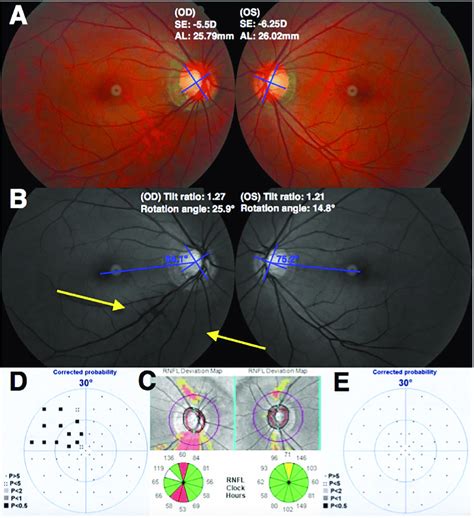 The Less Myopic Eye Had Greater Optic Disc Rotation And Glaucomatous