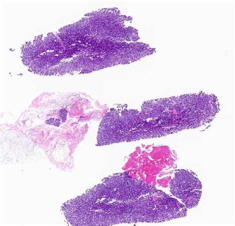Pathology Outlines Lactating Adenoma