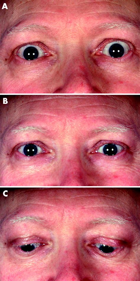 Full Thickness Eyelid Transsection Blepharotomy For Upper Eyelid