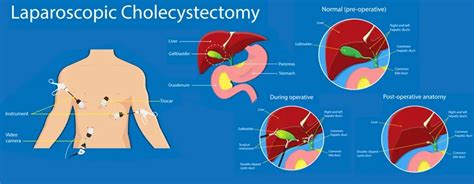 Laparoscopic Cholecystectomy Indications Preparation And Recovery
