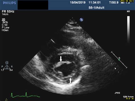 Atypical Marantic Endocarditis Bmj Case Reports