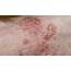 Comparative Efficacy Of Systemic Psoriasis Treatments Evaluated 