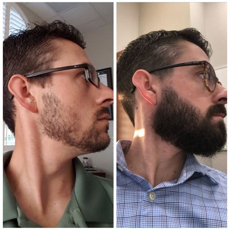Patchy Beard Success Stories Before And After Photos Page 27 Beard
