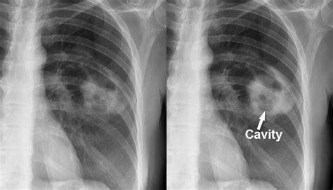 Chest X Ray Pulmonary Disease Lung Cavity