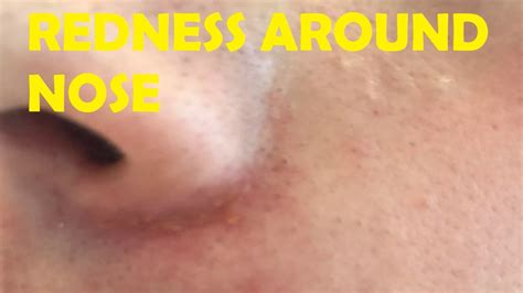 How To Get Rid Of Redness Around Nose Youtube