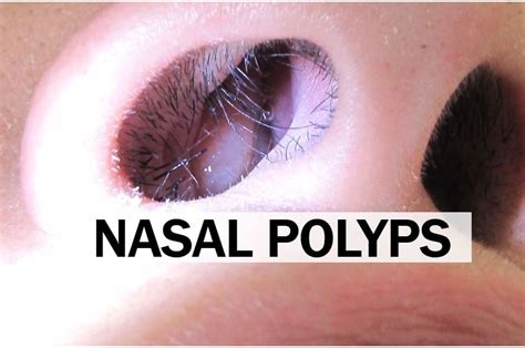 How To Tell Nasal Polyps At Versekering