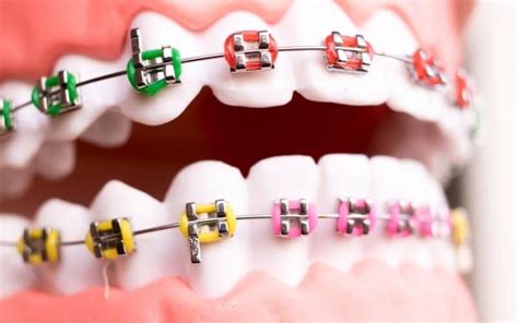 5 Myths Of Braces Busted Wilkinson Orthodontics Gold Coast