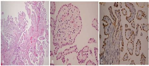 Well Differentiated Papillary Mesothelioma Of Peritoneum Microscopic