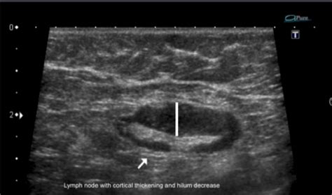 Swollen Lymph Node Armpit Ultrasound Images And Photos Finder