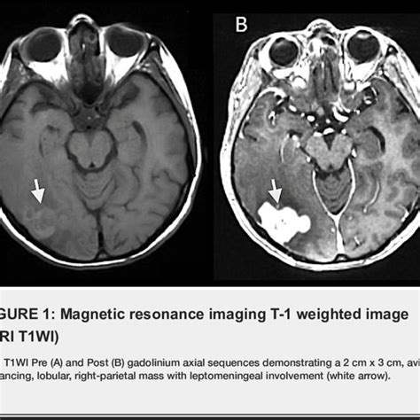 Magnetic Resonance Imaging T 1 Weighted Image Mri T1wi Mri T1wi Pre