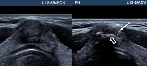 Transverse Images Of A 1 Cm Thyroid Isthmus Nodule Usin Open I