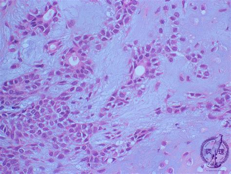 7oral Salivary Gland 7 Salivary Gland Tumor Pleomorphic Adenoma