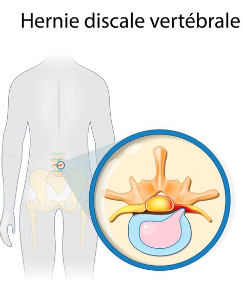 Hernie Discale Calcifi E Ou Molle Diagnostic Et Traitements