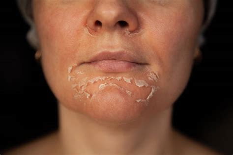 Dry Flaky Skin Stock Photos Pictures And Royalty Free Images Istock