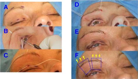 Frontalis Suspension Surgery To Treat Patients With Essential