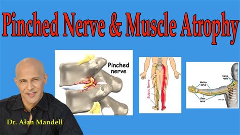 Pinched Nerve And Muscle Atrophy What You Should Understand Dr