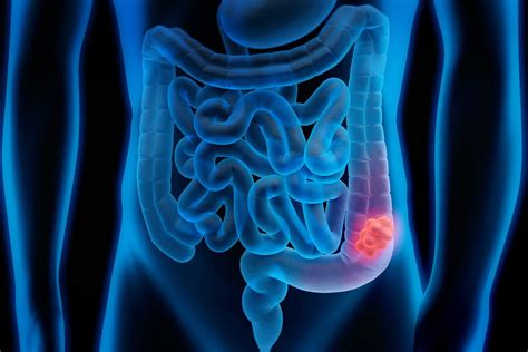 The Colon Cancer Stages What You Need To Know The Healthy