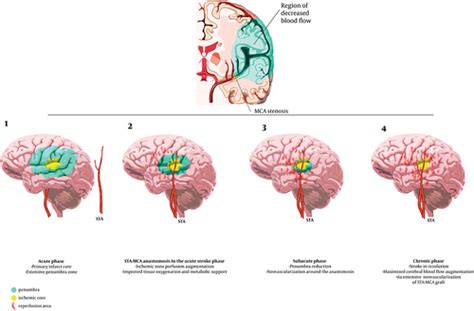 The Role Of Early Superficial Temporal To Middle Cerebral Artery Bypass