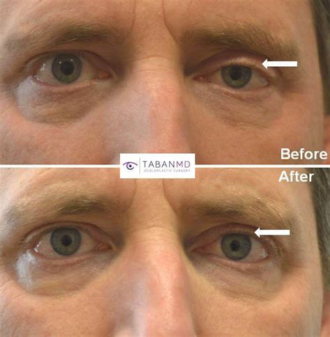 Ptosis Surgery Beverly Hills Droopy Eyelid Surgery Los Angeles
