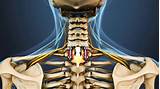 Side Effects Of Cervical Laminectomy Photos