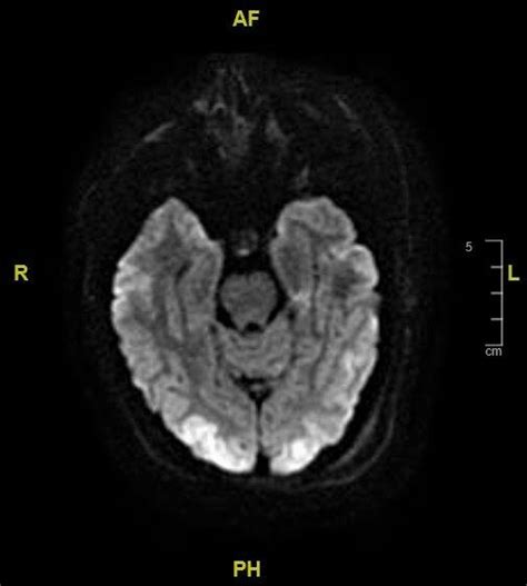 Brain Mri Demonstrating Mild Cortical Restricted Diffusion Within The