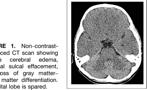 Figure 1 From The Role Of Scintigraphy In Confirmation Of Suspected