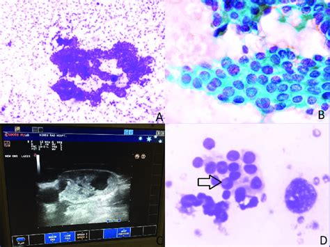 Case 1 Metastatic Papillary Thyroid Carcinoma In Cervical Lymph Node