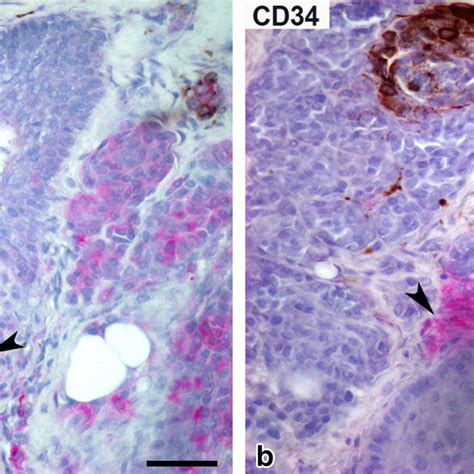Immunostaining For Nestin A And Cd B In Dysplastic Melanocytic