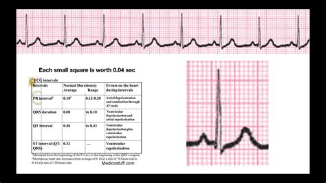 How To Determine Intervals And Segments On Ekg Explained Youtube