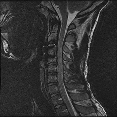 Magnetic Resonance Imaging After Acute Disc Herniation At C4 C5